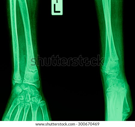 X ray of a wrist. Some film grain visible.