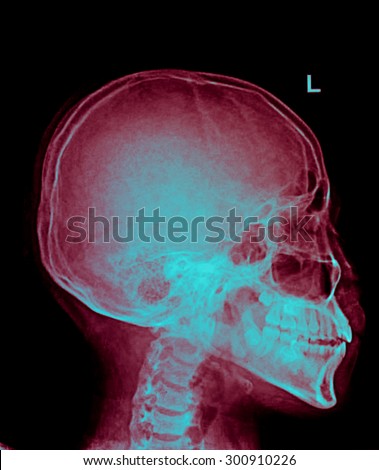 film x-ray human\'s skull and cervical spine