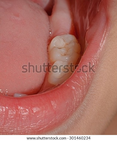 kid patient open mouth showing cavities