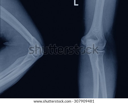 elbow x-rays ( Elbow joint Antero-posterior )on a black background