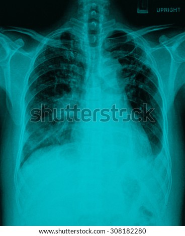 Chronic bronchitis, emphysema old pulmonary tuberculosis