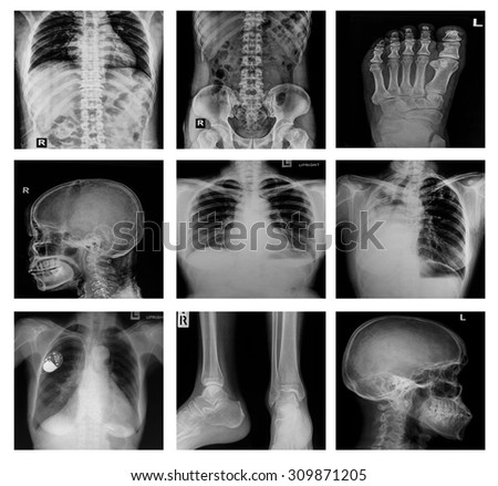 Collection X-ray Multiple part of human,orthopedic surgery and multiple disease