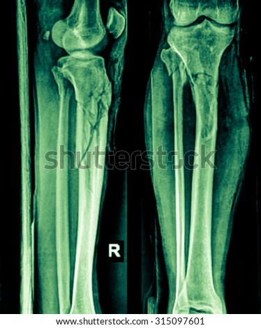 X-ray image of lower leg, AP view. Shows tibia fractures