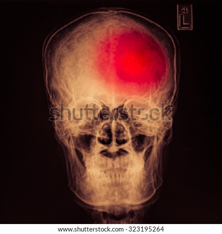 Stroke ( Cerebrovascular accident ) . film x-ray skull of human with red area ( Medical , Science and Healthcare concept and background )