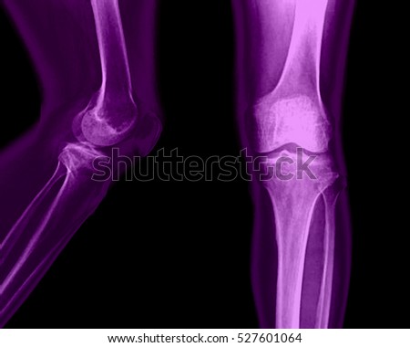 Film x-ray knee AP/lateral : Osteoarthritis knee
