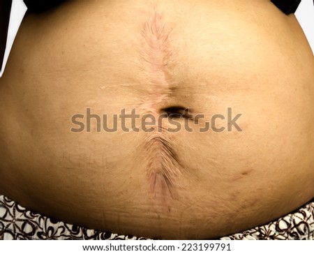 Abdominal scar from the surgery.cesarean