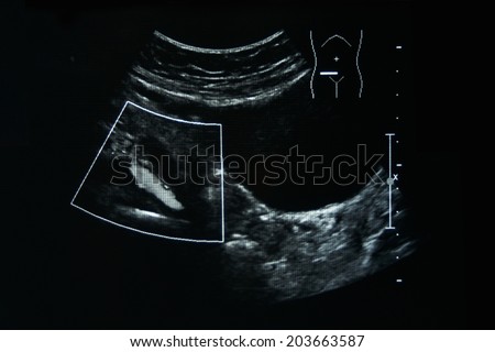 Ultrasound film of a woman right ureter abnormal with the black background.
