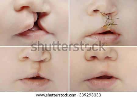 Closeup on lips of baby with lip and palate cleft before and after surgery.