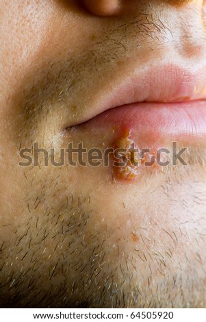 herpes sores or plantar warts. herpes sores on face. stock
