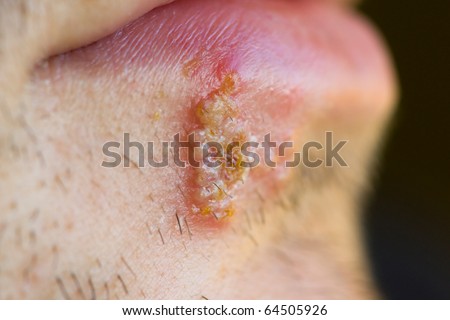 Cold sores (herpes labialis)