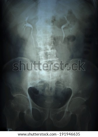 X-ray film of the pelvis and spinal column.