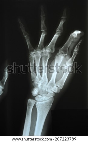 Hand x-ray image medical background