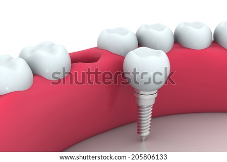 Dental implant human Tooth Dental implant human Tooth