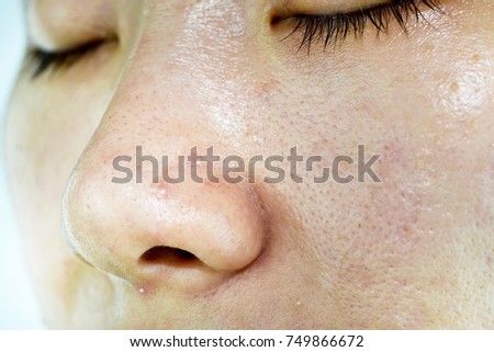 Skin problem with acne diseases, Close up woman face with whitehead pimples on nose, Scar and oily greasy face, Beauty concept.