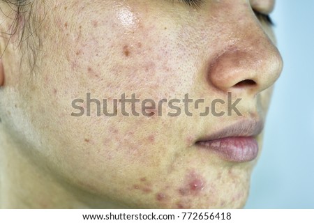 Skin problem with acne diseases, Close up woman face with whitehead pimples, Menstruation breakout, Scar and oily greasy face, Beauty concept.