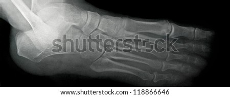 Foot X-ray, Lateral View