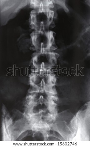 X-ray, Lumbar Spine
