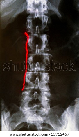 X ray, Lumbar Spine with Red Laser