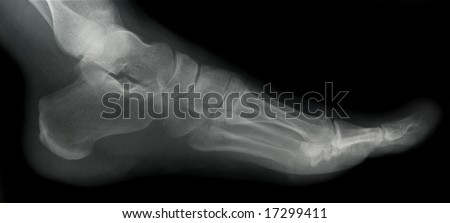 Foot X-ray