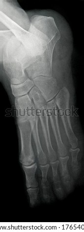 Lateral Foot X-ray