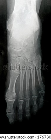 Anterior Foot X-ray