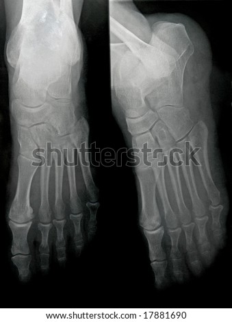 Double Foot X-ray