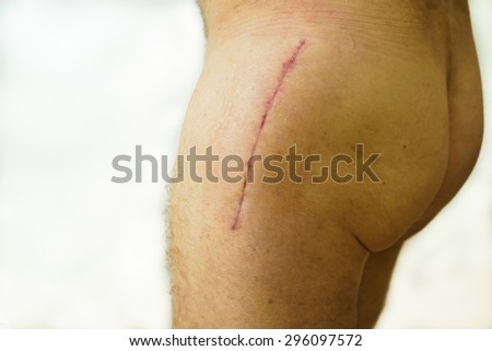 Full hip replacement scar (20 cm) in a month after surgery