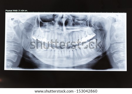 Human dental panoramic x-ray photo