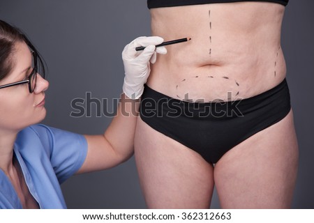 Surgeon, liposuction, body.Cellulite, stretching.Overweight, obesity, fat woman, fat belly, hips and excess weight