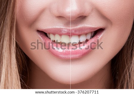 Female teeth whitening before and after the procedure, big lips mouth open, straight beautiful teeth