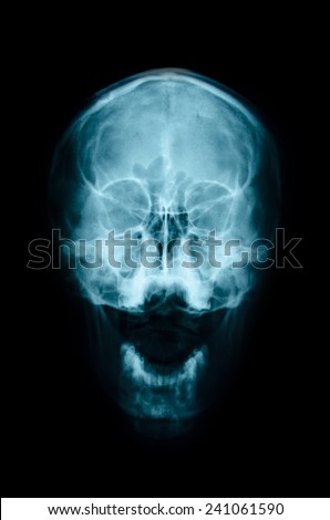 film x-ray Skull AP : show normal human\'s skull and blank area at front side