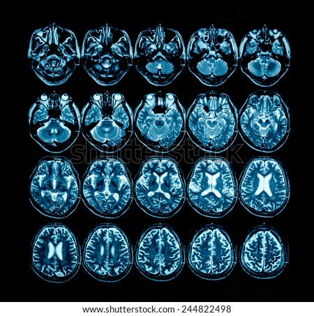x-ray film of the brain computed tomography, MRI