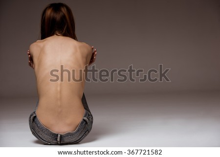 A girl with anorexia turned back, spine and ribs visible