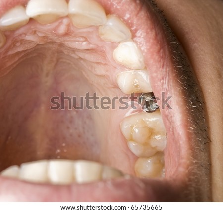 Dentistry implant in the mouth men