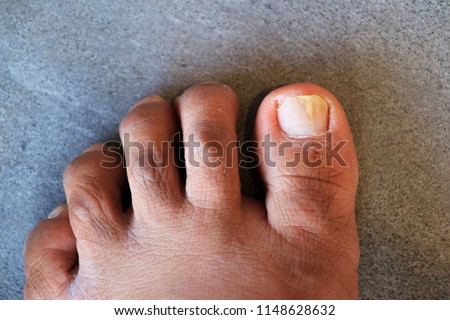 onychomycosis foot nail fungus white