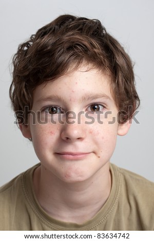 stock photo Portrait of a cute teenage boy with face covered with pimples