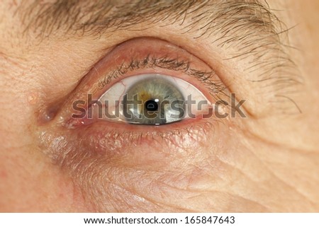 opening human eye with red eyeball