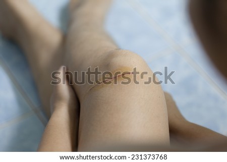 scars on her leg