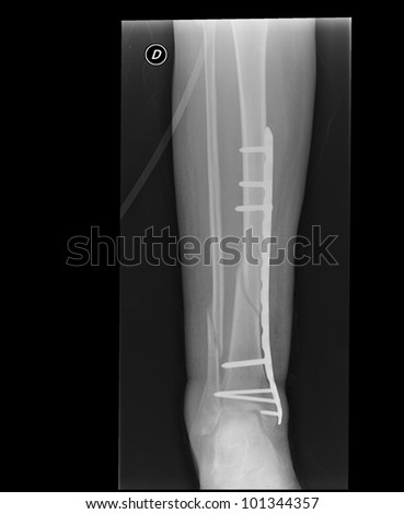 Broken leg