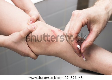 close-up of a boy\'s scratched injured leg, getting first aid, hurt in pain, clenching his leg