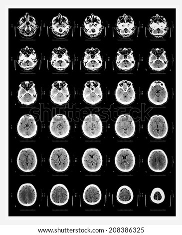 Computer axial tomography scan (CAT scan)