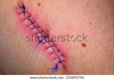 Stitched up wound after mole removal surgery.