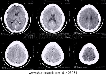 ct scan of 30 year old male skull and brain