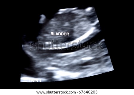 first trimester ultrasound baby xray of Fraternal twin bladder