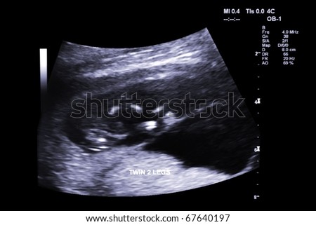 first trimester ultrasound baby xray of Fraternal twin legs