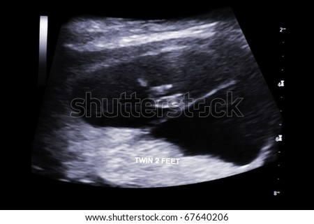 first trimester ultrasound baby xray of Fraternal twin feet