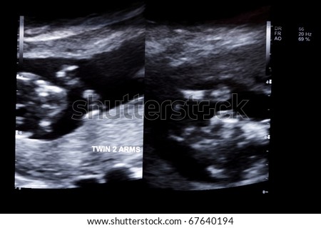 first trimester ultrasound baby xray of Fraternal twin arms and hand