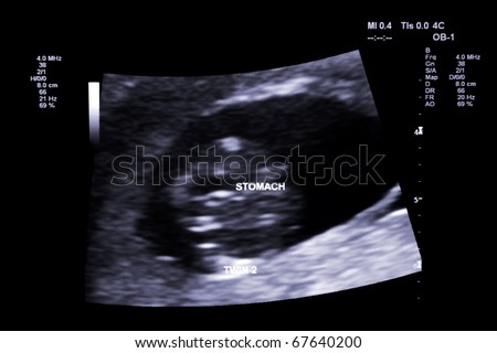 first trimester ultrasound baby xray of Fraternal twin stomach