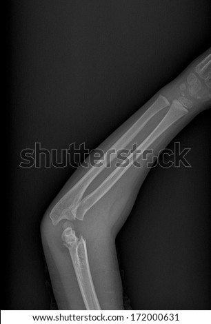 X ray of broken arm with humerus fracture