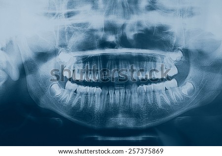 Medical X ray imaging of human teeth of a child